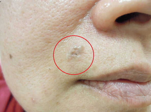 52岁王姓妇人脸上出现透亮胶状感肿瘤,竟然是皮肤细胞癌.