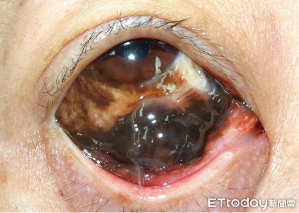 下眼睑爆「黑珍珠」竟是恶性黑色素瘤 44岁女摘眼保命