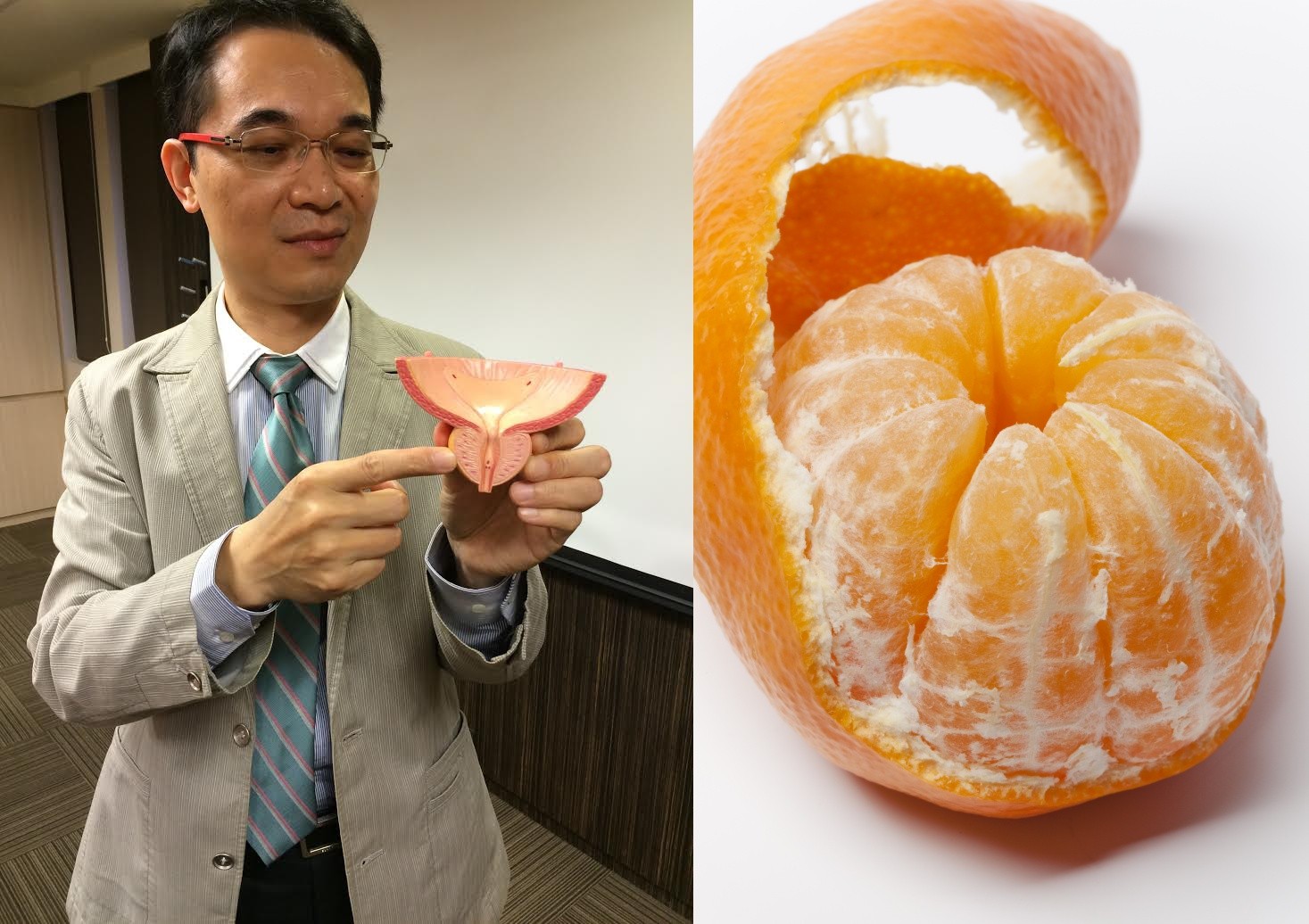 醫：攝護腺是顆「小橘子」，內視鏡手術就像在「挖果肉」。（圖／書田診所提供、達志示意圖）
