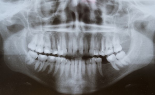 牙齒,牙周病,X光。（圖／達志／示意圖）