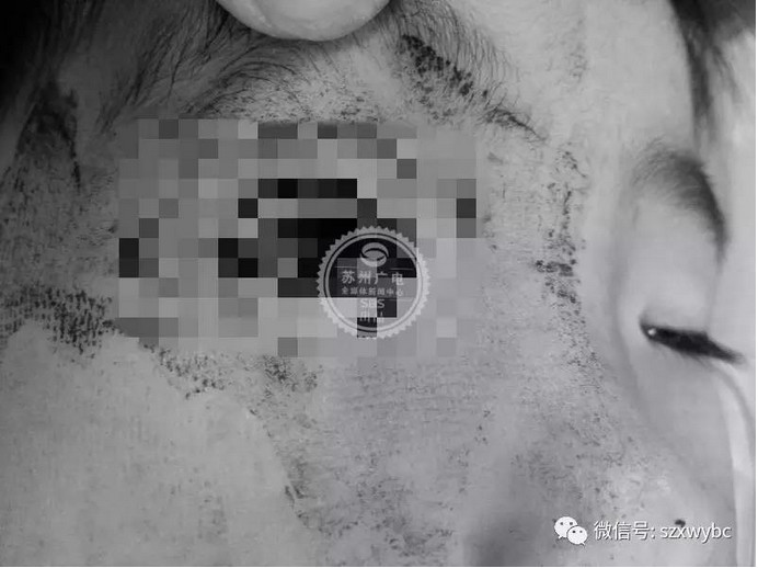 老爸玩弹弓失手 3岁儿右眼被「射爆」不停流浆