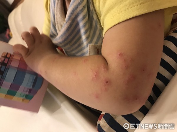 男童身上細菌感染後，身上產生多處膿痂疹。（圖／童綜合醫院提供，以下同）