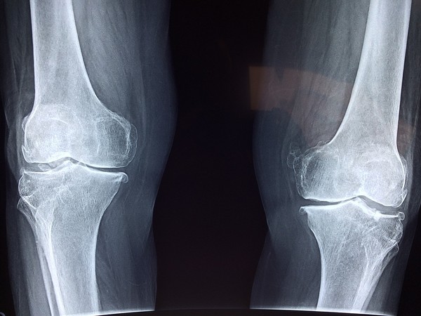 ▲膝蓋。（圖／翻攝自pixabay）