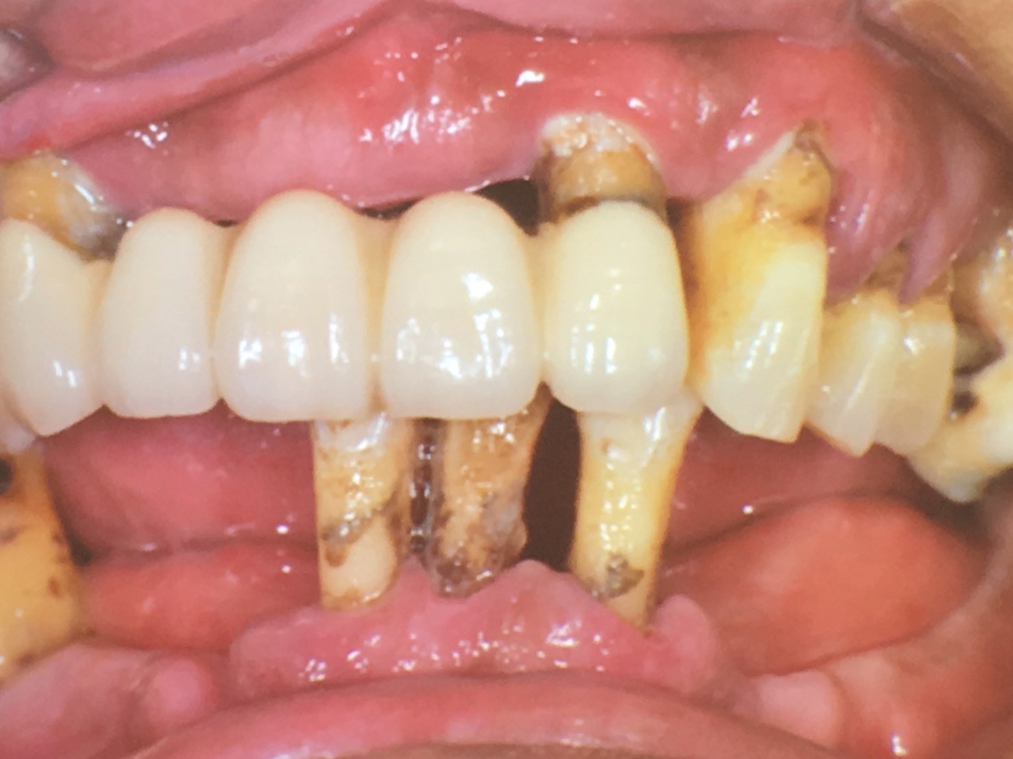 ▲牙菌斑堆積是牙周病的根源，使支撐牙齒的骨頭流失，造成牙齦萎縮，牙縫變大，嚴重會使牙根顯露出來，甚至需拔牙。（圖／記者林悅翻攝）