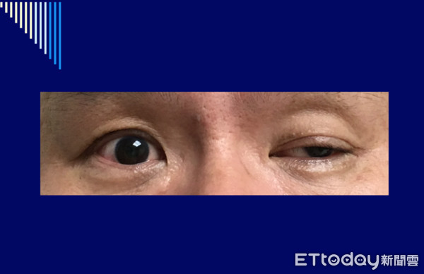 ▲沒睡飽？左側眼瞼突下垂　50歲男意外揪出「腦中風」。（圖／書田診所提供）