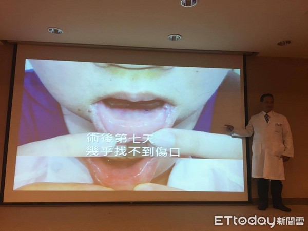 ▲甲狀腺手術像「割喉」　新技術「下唇戳3洞」就能拉出來。（圖／記者嚴云岑攝）