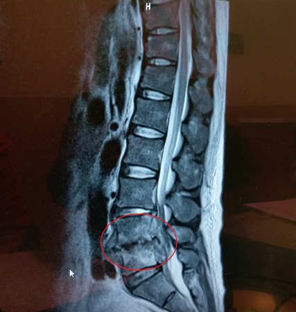 化膿性脊椎炎發生時，脊椎骨中間的間隙被侵蝕掉(如紅色圈圈處)，膿水壓迫到大神經，因此容易造成下肢疼痛的現像。（圖／大千綜合醫院提供）