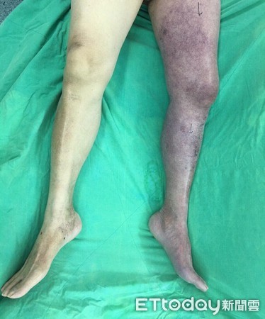 ▲腳痛險要命！高醫內外科聯手搶救那條紫色的腿。（圖／高醫提供）