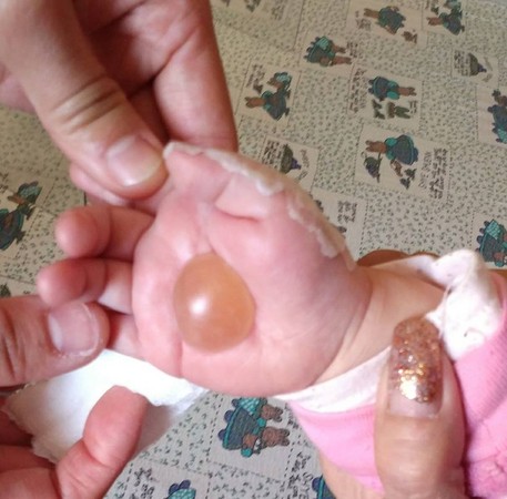 ▲10月大女嬰遭護理師燙傷，手掌出現巨大水泡。（圖／翻攝自爆料公社）