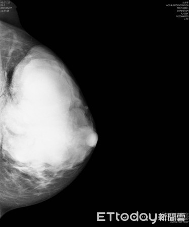 兩乳房F比B   原是葉狀瘤。（圖／彰化醫院提供）