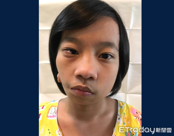 ▲緬甸女童右耳只有「2坨肉」　台醫要花8個月幫她做新臉。（圖／中國附醫提供）