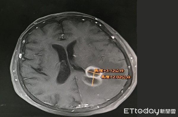 ▲▼核磁共振顯示阿嬤左後腦有不尋常顯影合併水腫。（圖／烏日林新醫院提供）