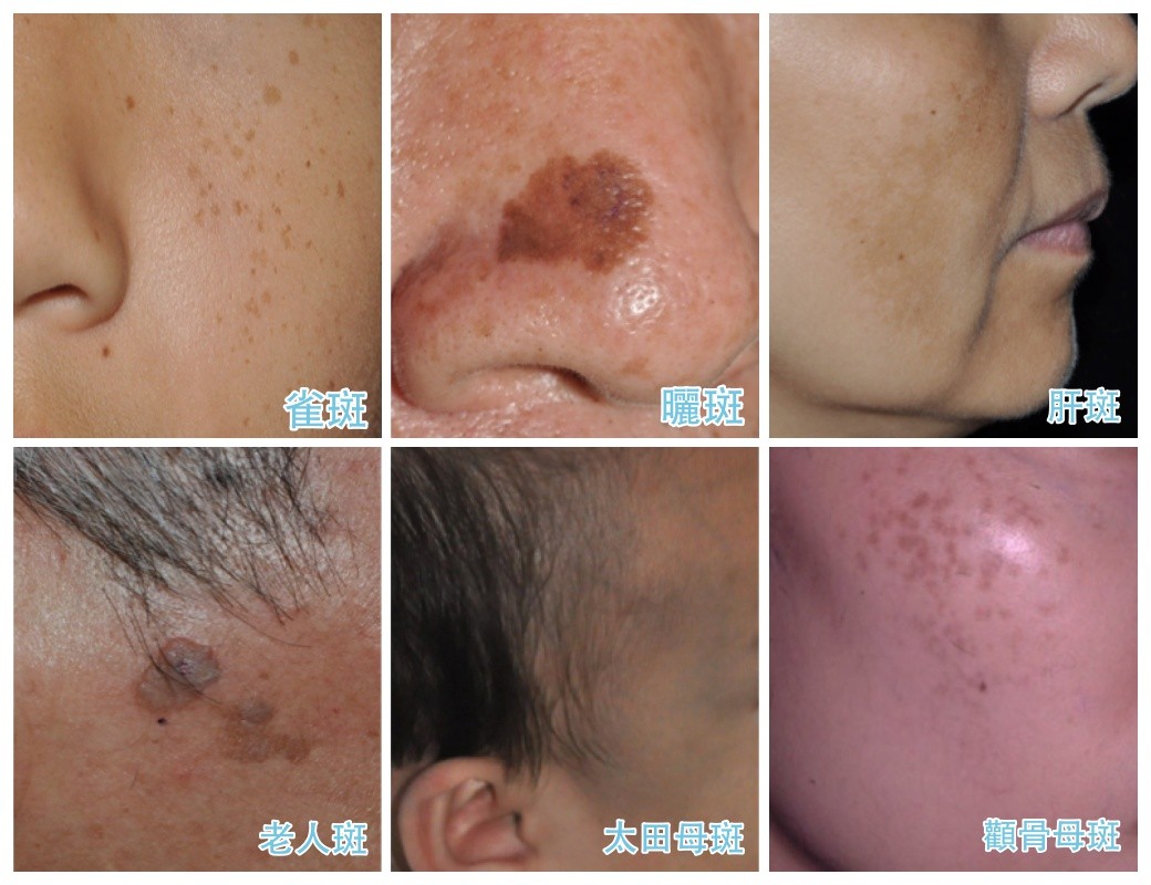 形狀、顏色大不同！台灣人常見6種斑　快檢查臉上有沒有。（圖／紀敏慧醫師提供）