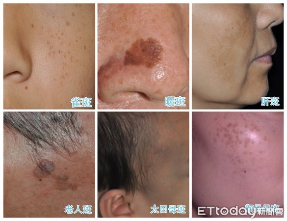 形狀、顏色大不同！台灣人常見6種斑　快檢查臉上有沒有。（圖／紀敏慧醫師提供）