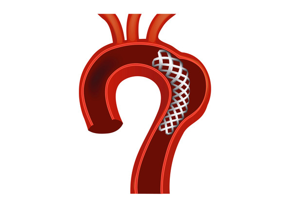 ▲▼圖片2913：亞大醫院心臟血管外科主任劉殷佐指出胸主動脈瘤剝離位置。支架置放示意圖：右邊凸起處為胸主動脈瘤位置。。（圖／亞大醫院提供）