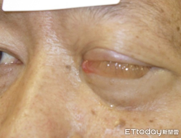 ▲▼治療前的左眼，因腫瘤在兩週內快速生長而造成左眼腫脹、完全打不開。（圖／高雄長庚醫院提供）
