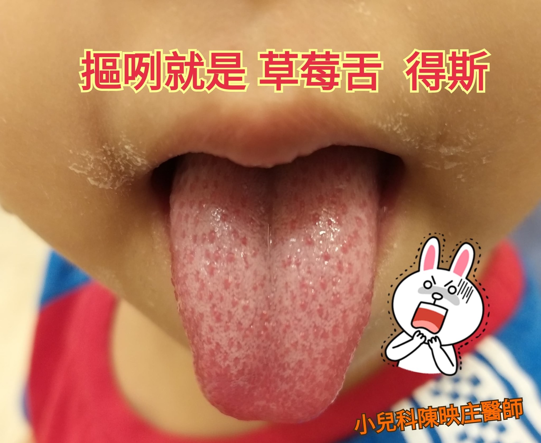 发烧先看舌头!孩子张口见「草莓舌」快送医 医:有3致命疾病