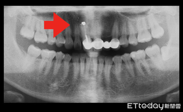 ▲門牙腫脹還有「小黑點」　這病28歲的她險成「缺牙新娘」。（圖／三總提供）