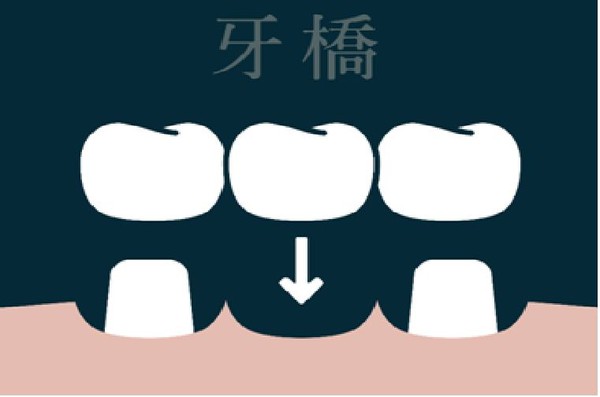 ▲▼缺牙除了選擇植牙，還有其他2種方式可以選擇。（圖／醫師游惠捷提供）