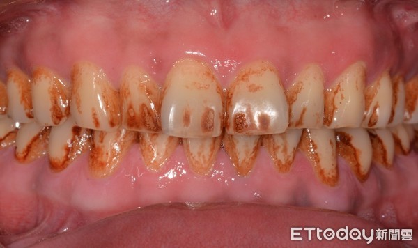 ▲美白粉別亂塗！醫解析牙齒泛黃、發黑3大原因。（圖／康捷診所提供）