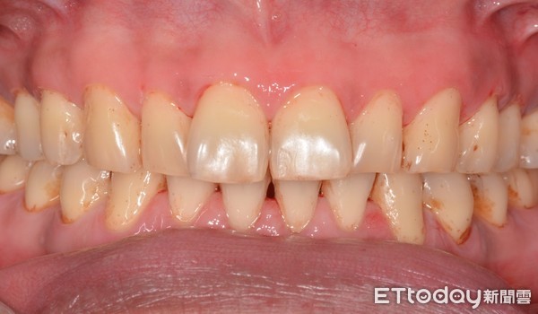 ▲美白粉別亂塗！醫解析牙齒泛黃、發黑3大原因。（圖／康捷診所提供）