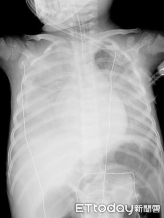 ▲▼急性呼吸道窘迫症候群（ARDS)患者的肺部X光片呈現一片慘白。（圖／吳昌騰醫師提供）