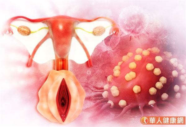 子宮肌瘤會釀子宮內膜癌，非切不可？必知子宮肌瘤6大併發症，多吃花椰菜護肝